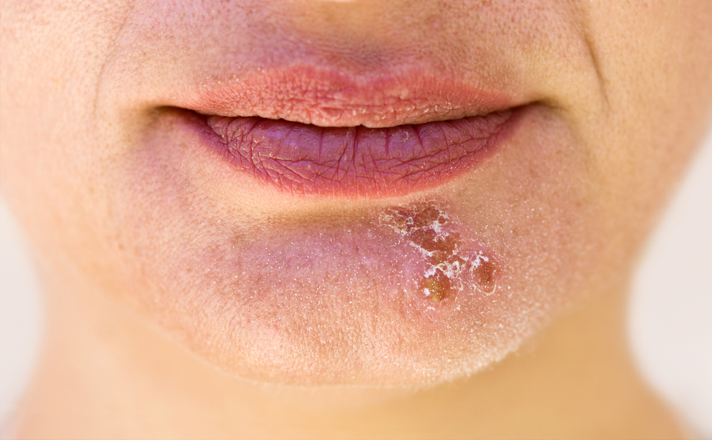 5-common-causes-of-mouth-ulcers-bacchus-marsh-dental-house